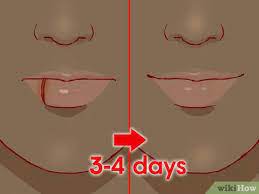 Most cuts to the mouth stop bleeding within 5 to 10 minutes with pressure applied. How To Treat A Cut Lip With Pictures Wikihow