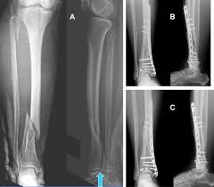 What does maisonneuve fracture mean? Concomitant Tibial Shaft And Posterior Malleolar Fractures Can Be Readily Diagnosed From Plain Radiographs A Retrospective Study Sciencedirect