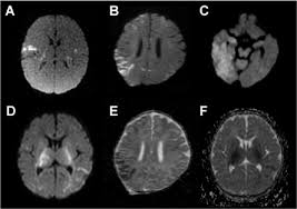 This is the first study that compared the serum sodium levels. Diffusion Weighted Mri For Early Diagnosis Of Neonatal Herpes Simplex Encephalitis Sciencedirect