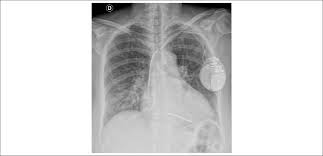 Case 3 2018 A 60 Year Old Female With Chagasic Heart Disease Admitted Due To Heart Failure Decompensation Cachexia And Pulmonary Infection
