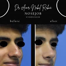 Dr Amr Nabil (@cairorhinoplasty_amr_nabil) • Fotos y videos de Instagram