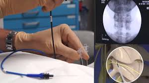 Image result for Radiofrequency Surgery