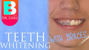 Want to know how to whiten teeth naturally? Braces Hacks To Keep Your Teeth White Teeth Whitening With Braces And Invisalign Youtube