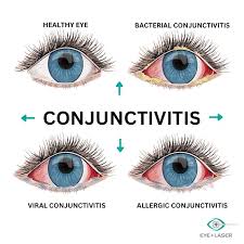 Image result for Allergic Conjunctivitis