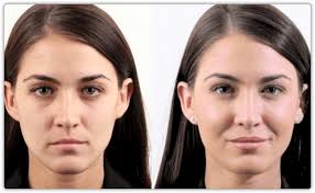 Cheek fillers can restore contours to the cheeks and midface, revitalizing your appearance. Dermal Filler Treatments In Toronto Mississauga Lip Doctor