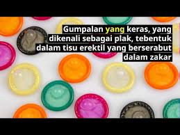 Ubat keraskan zakar ini merupakan salah satu daripada pde5 inhibitors yang menggunakan avanafil sebagai bahan utamanya. Zakar Bengkok Bent Penis Rawatan Masalah Kemaluan Doctoroncall