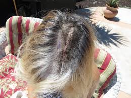 The Healing Machine Brain Surgery Recovery Brain Surgery Brain Tumor