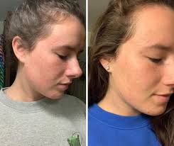 What are some suggestions for a 3-year-old child's sensitive skin breakout?