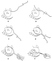 In this video the doctor explains what happens when they use forceps to deliver a baby. Forceps Delivery And Vacuum Extraction Glowm