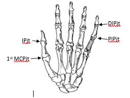 Image result for Interphalangeal Dislocation