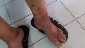About Diabetic Dermatitis What Is Diabetic Dermopathy Necrobiosis Lipoidica Diabeticorum Eczema Treatment Dermatitis Treatment Dermatitis