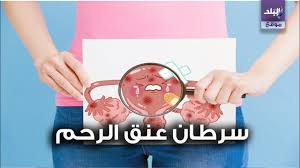 مراحل سرطان عنق الرحم Youtube