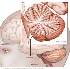 Image result for Ataxia