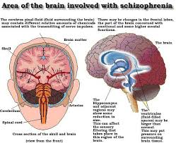 Matter Over Mind Schizophrenia What Causes Schizophrenia Schizophrenia Causes