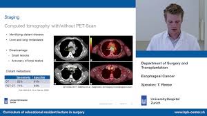 Esophageal cancer (or oesophageal cancer) is malignancy of the esophagus. Esophageal Cancer Youtube