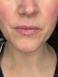 Lines above lips : r/40PlusSkinCare