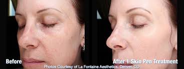 Copyleft derivative and combined works must be licensed under specified terms, similar to those on the original work Rid Yourself Of Raccoon Eyes T Douglas Gurley Md