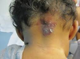 Image result for Nevus Simplex