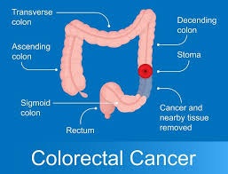 Image result for Colon Cancer Screening with Colonoscopy