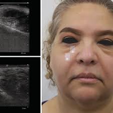 The picture shows the local spreading of the allergic reaction