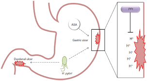 Top Ulcer Treatment Mechanisms