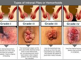 However, an internal hemorrhoid can. Piles Surgery Lady Doctor In Anantapur