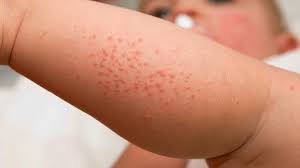 Image result for sweat rash on back baby