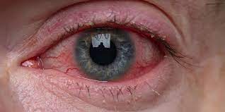Is It Covid 19 Or Allergies American Academy Of Ophthalmology