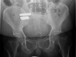 Wann kann ein bandscheibenvorfall konservativ behandelt werden? Nicht Immer Ist Die Bandscheibe Die Ubeltaterin Gesundheit