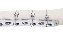 Orthopaedic Cable System | DePuy Synthes | J&J MedTech US