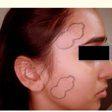 Demarcation for the subsequent repositioning of electrodes in the...