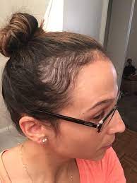 As a result, some women may. My Experience With Hair Loss After Pregnancy Photo Included Simply In The Flavor