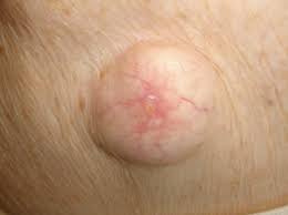 Sju år senere fikk han en ubehagelig. Epidermoid Cyste Nhi No