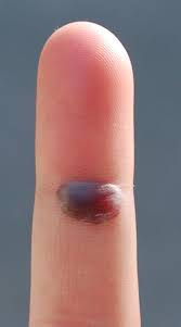 Maybe you would like to learn more about one of these? Blood Blister Symptoms Causes Diagnosis