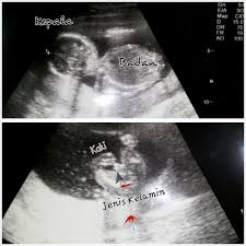 Pada akhir bulan ketiga kehamilan, bayi kamu sudah terbentuk sempurna. 17 Minggu 3 Hari Pnajang 11 3 Cm Normal Tak Ibuhamil Com