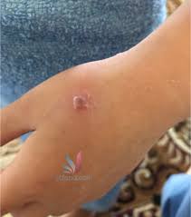 Pertama sekali, kalau tahu anak demam kena chicken pox, wajiblah bawa anak jumpa doktor ya. Resepi Makanan Untuk Chicken Pox Dunia Belajar