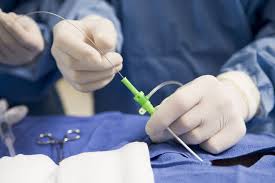 Katheter Ablation Bei Vorhofflimmern
