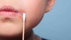 EXPERT ADVICE: How do I get rid of my cold sore?