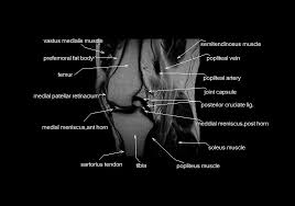 The patellofemoral articulation, consisting of the patella, or kneecap, and the patellar groove on the front of the femur through which it slides; Mri Knee Anatomy Knee Sagittal Anatomy Free Cross Sectional Anatomy