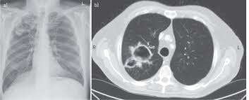 Invasive aspergillosis affects people who have weakened immune systems (such as those who've had a stem cell transplant or organ transplant), are undergoing chemotherapy for cancer, or getting high. Chronic Pulmonary Aspergillosis Rationale And Clinical Guidelines For Diagnosis And Management European Respiratory Society