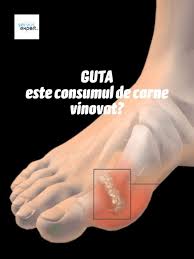 Guta reprezintă una dintre formele de artrită și provoacă dureri dureroase în cazul de ce este cel mai frecvent afectată îmbinarea degetului mare? Pin On Sanatate Remedii Tratamente