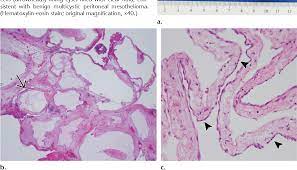 This type of tumor usually affects women between ages 20 and 40. Benign Multicystic Peritoneal Mesothelioma 1 Semantic Scholar