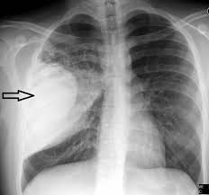 Easily identifiable and clinically useful predictor of positive mycobacterial culture from pleural fluid. Lesson 3 1 Inflammatory Surgical Diseases Of Thorax
