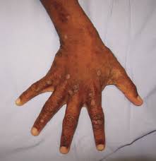 Image result for scabies on humans