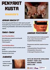 Jabatan pendaftaran negeri sembilan jabatan kebajikan masyarakat batu pahat jabatan penerangan malaysia sarawak jadual ets ke selatan jadual ets ke utara jadual gaji kerajaan 2019 jabatan kastam diraja malaysia gst jadual gaji pencen 2018. Pendatang Asing Punca Kusta Merebak Pusat Sejahtera Usm Facebook
