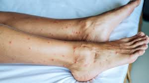 Image result for bedbugs bites