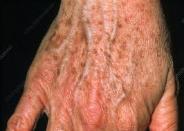 A common complaint is the appearance of white spots on skin. Lentigo Liver Spots On A 53 Year Old Woman S Hand Stock Image M200 0121 Science Photo Library