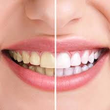 In the terms of molding or fitting the mouth guards into your teeth, here are some steps which should be known. Teeth Whitening Tooth Suite Family Dentistry Lloydminster Dentist