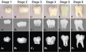 Developmentally Staged Extracted Human Third Molar Wisdom Teeth Tooth Download Scientific Diagram