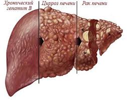 Gepatit B V Simptomy Profilaktika Kak Lechit Gepatit B Gepatit Ru